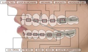 braces north burnaby